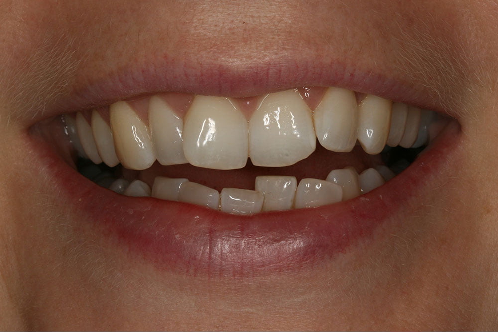 Patient Gallery &#8211; Invisalign