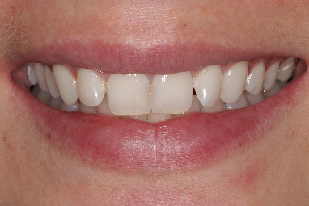 Patient Gallery &#8211; Composite Bonding