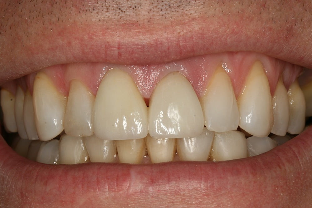 Crooked teeth veneers before and after