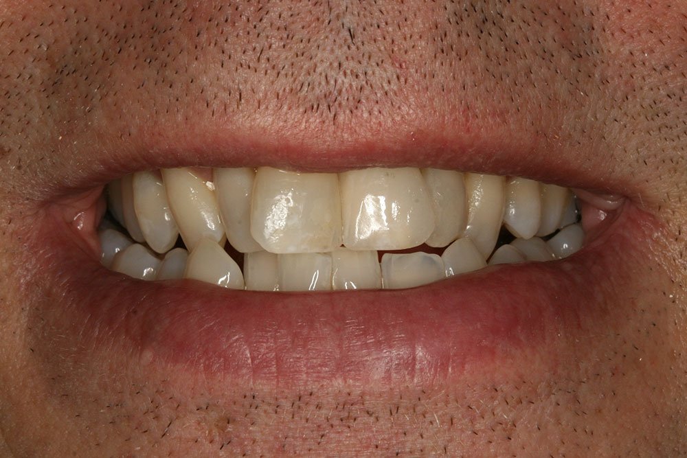 Dental Implants