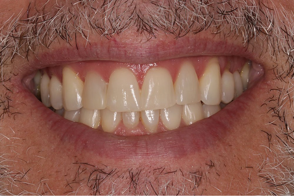 Patient Gallery &#8211; Composite Bonding