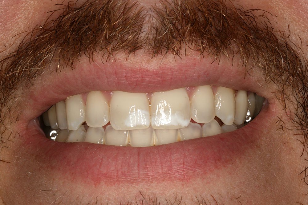 Patient Gallery &#8211; Invisalign