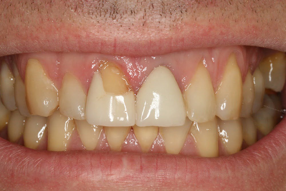 Crooked teeth veneers before and after