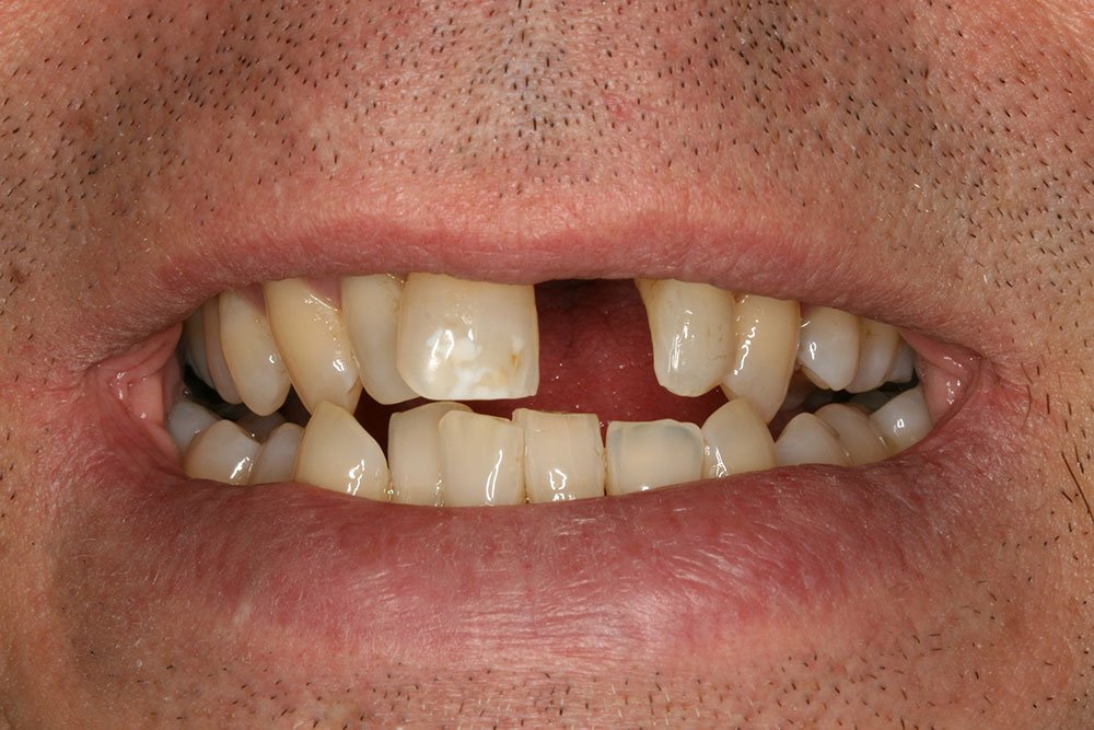 Dental Implants