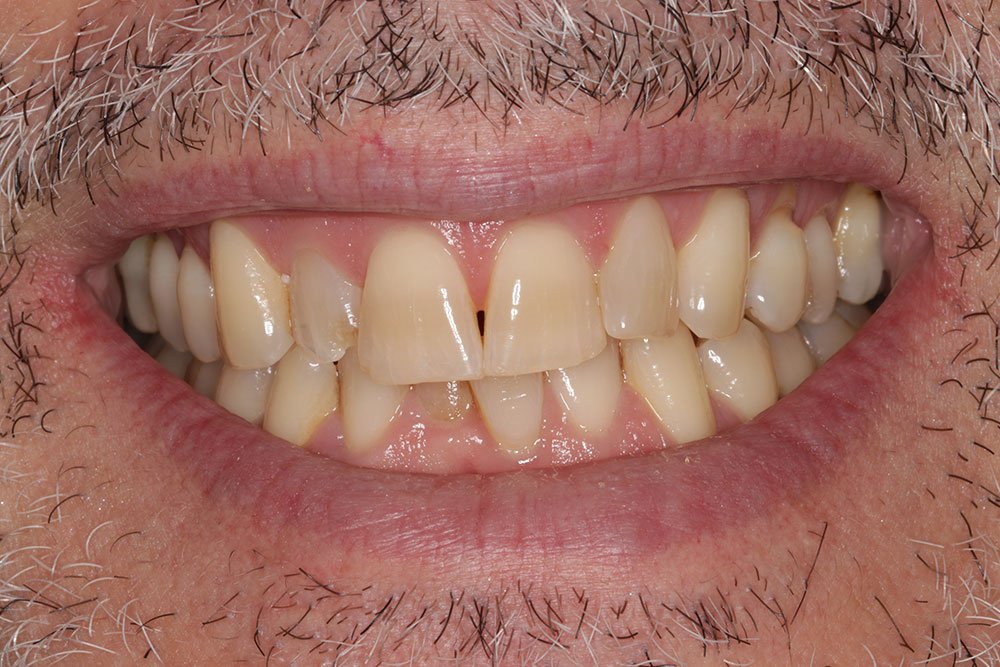 Patient Gallery &#8211; Composite Bonding