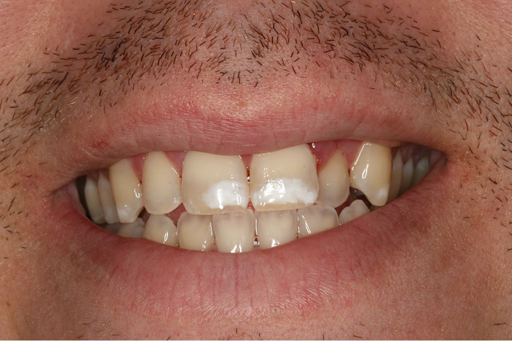 Patient Gallery &#8211; Invisalign