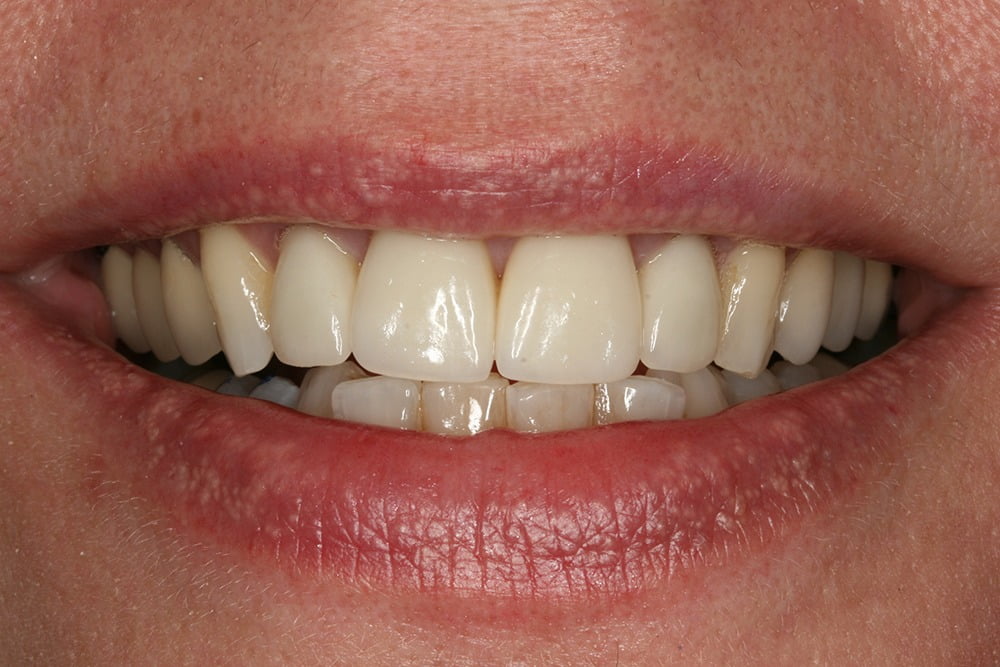 Crooked teeth veneers before and after