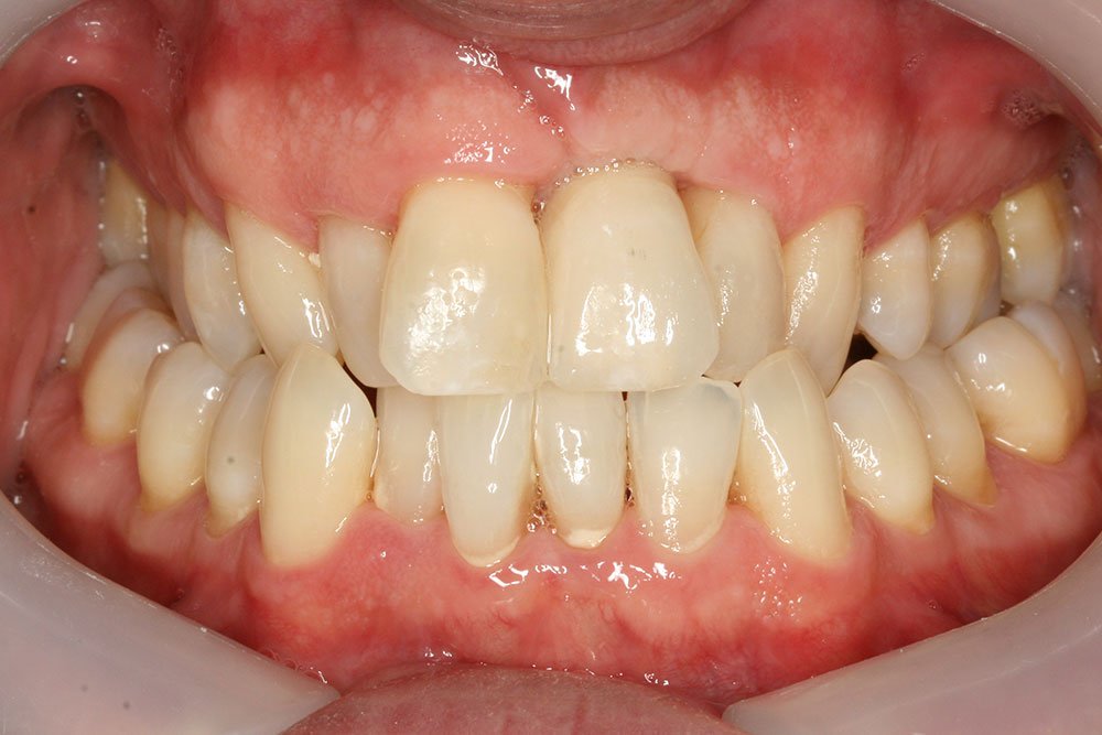 Patient Gallery &#8211; Dental Implants