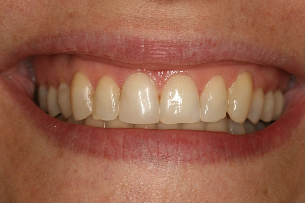 Patient Gallery &#8211; Composite Bonding