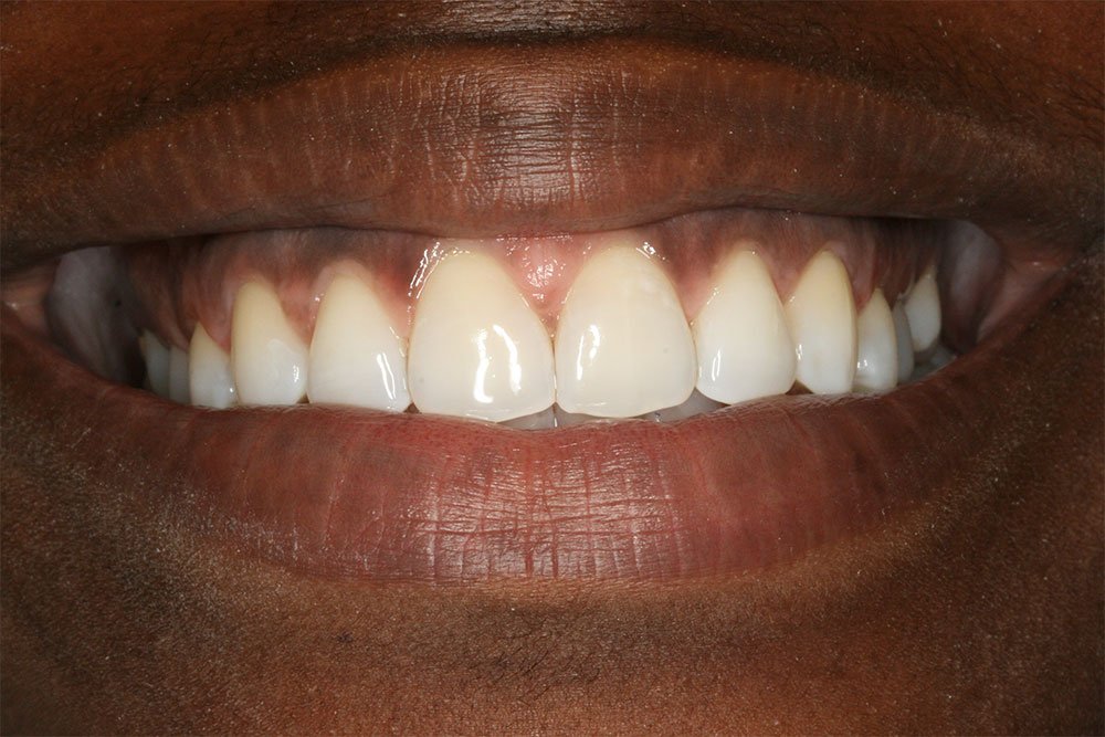 Patient Gallery &#8211; Invisalign