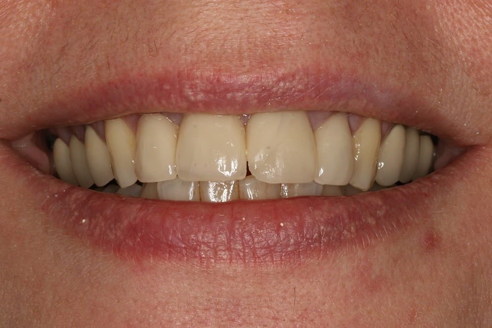 Crooked teeth veneers before and after