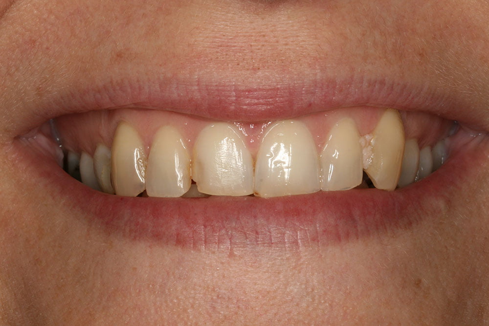 Patient Gallery &#8211; Composite Bonding