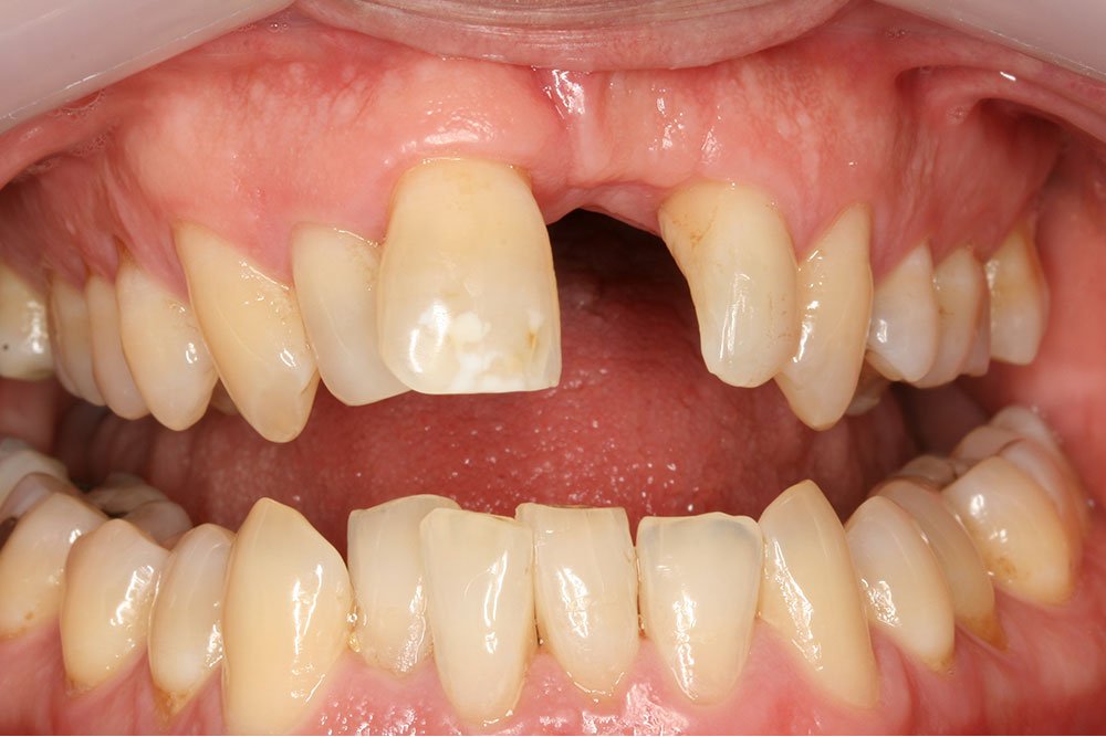 Patient Gallery &#8211; Dental Implants