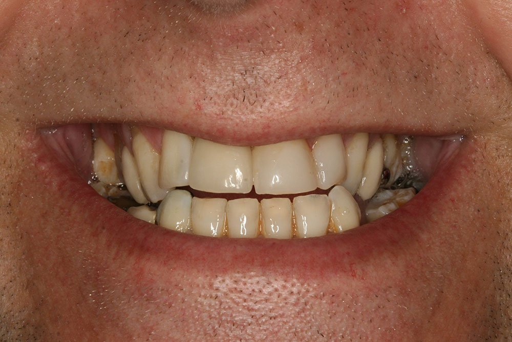 Patient Gallery &#8211; Dental Implants