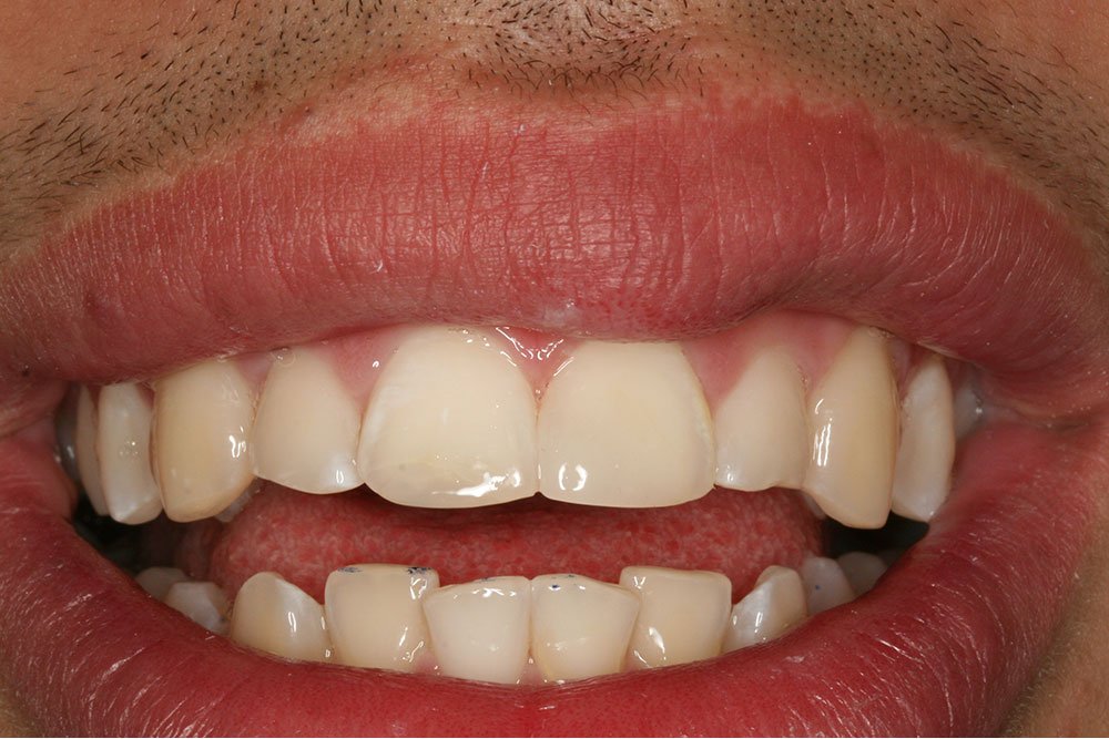 Patient Gallery &#8211; Composite Bonding