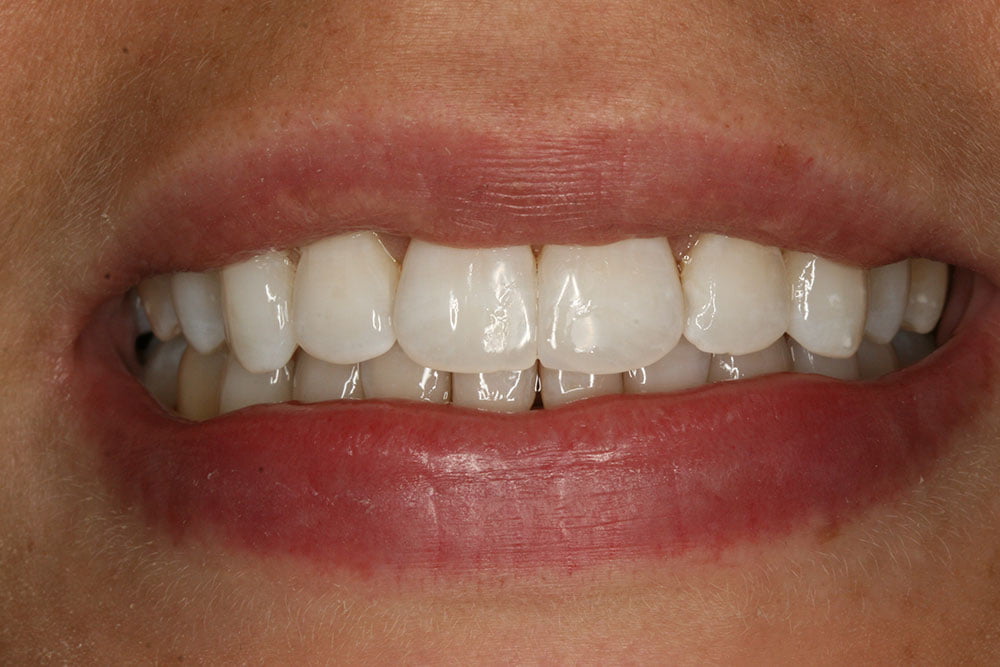 Patient Gallery &#8211; Invisalign