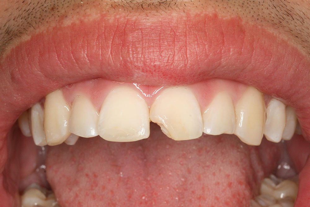 Patient Gallery &#8211; Composite Bonding