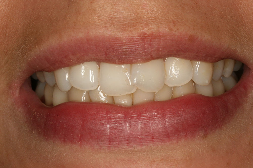 Patient Gallery &#8211; Invisalign