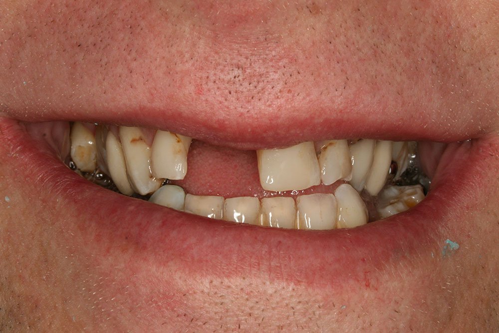 Patient Gallery &#8211; Dental Implants