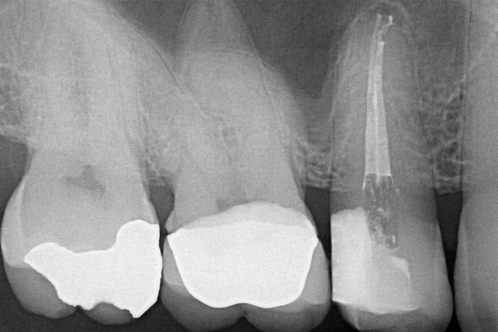 Root Canal Treatment