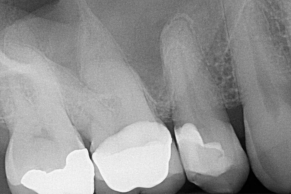 Root Canal Treatment